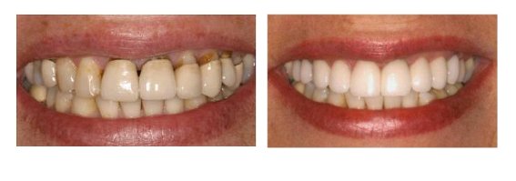 Dental Crown Before And After