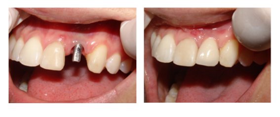 Dental Implants Before And After