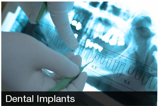 Dental Implants Promotion Image