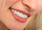 Porcelain Dental Veneers Promotion Image