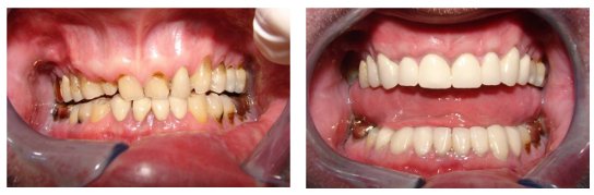 Dental Crowns Before and After