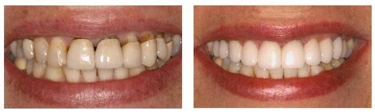 Dental Crowns Before and After