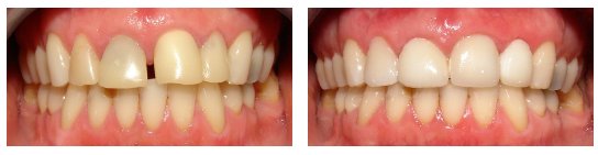 Dental Crowns Before and After