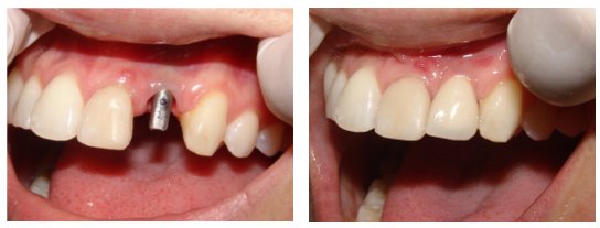 Dental Implants Before and After