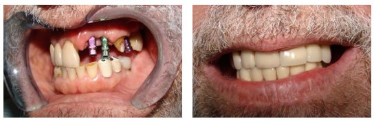 Dental Implants Before and After