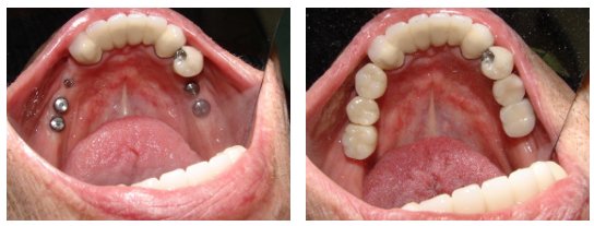 Dental Implants Before and After