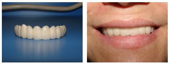 Dental Implants Before and After