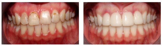 Dental Veneers Before and After