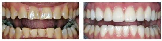 Dental Veneers Before and After