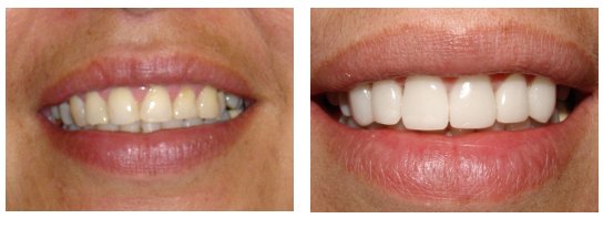 Dental Veneers Before and After