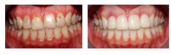 Dental Veneers Before And After