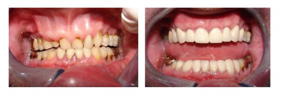 Smile Design Before And After